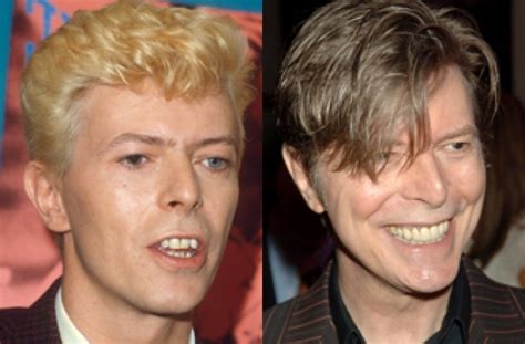 david bowie teeth before and after